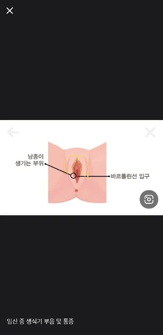 17주중반넘어가는데생식기부음