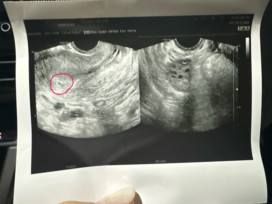 어제 4주0일차 초음파보고왓어용