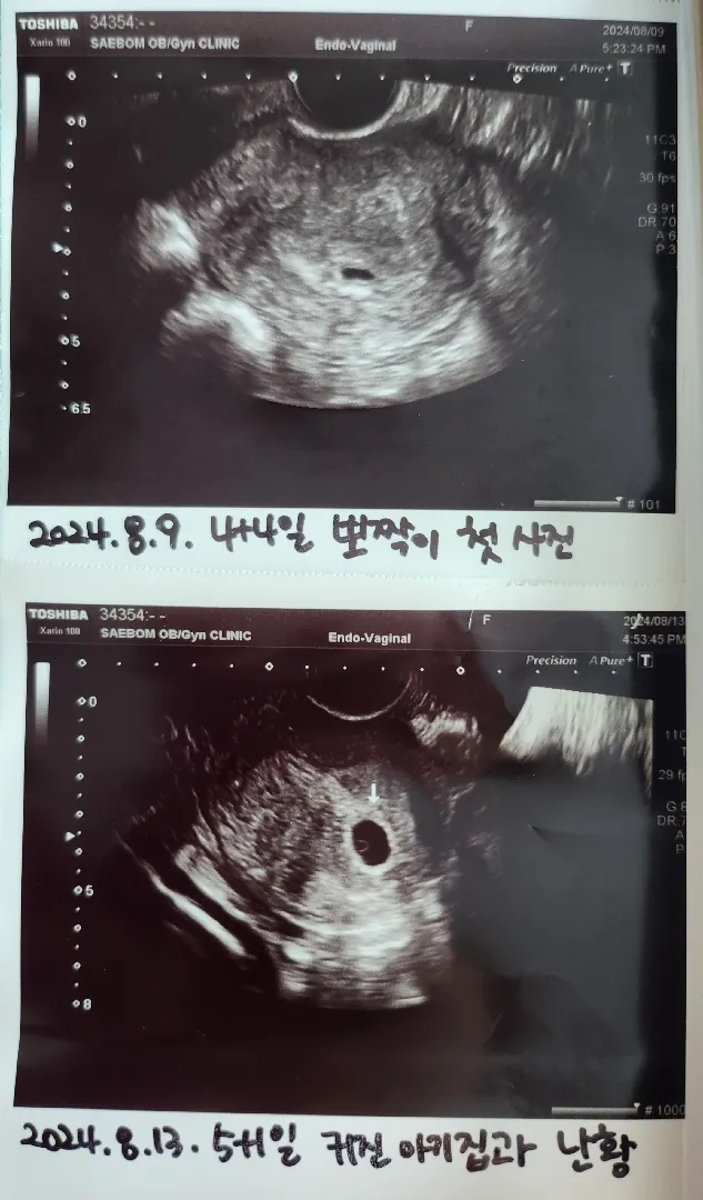 5주1일 난황보고왔어요!