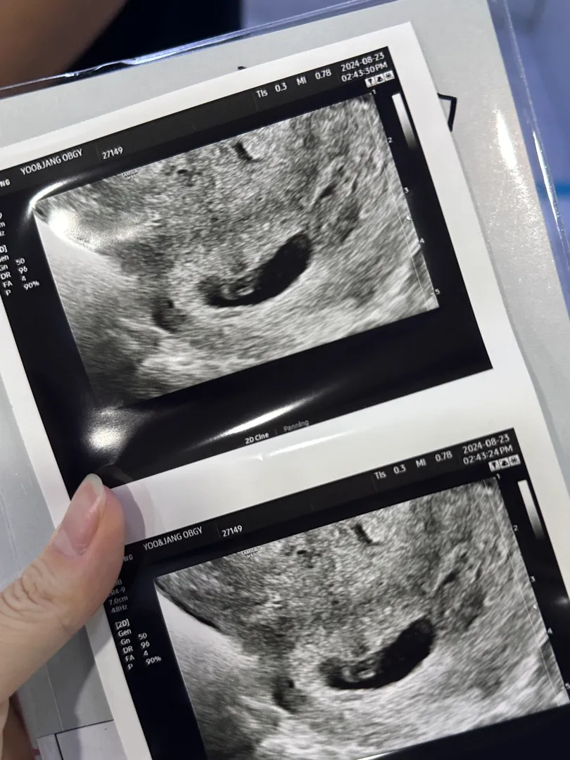 95% 유산 소견이었는데....!!!