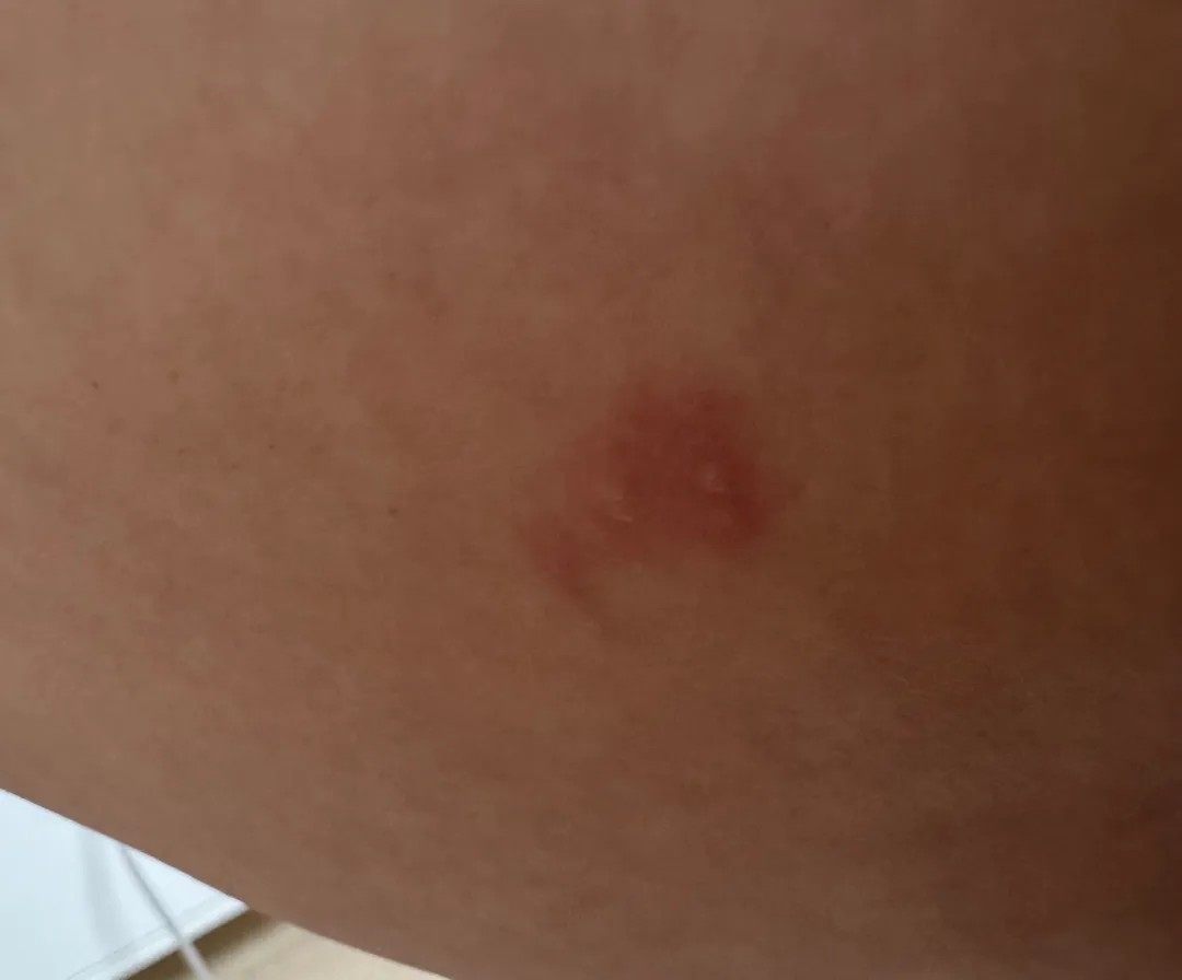대상포진일까요 ㅠㅠ? 