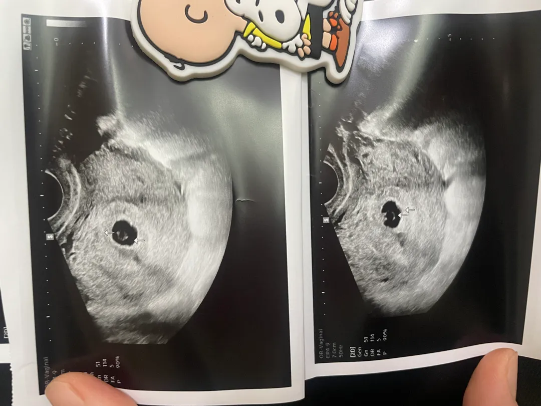 초음파사진