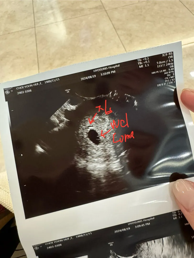 5주4일차 어제 초음파보고왔어요 모양어때요?