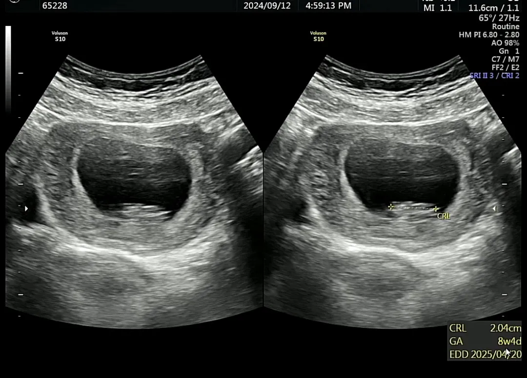 8W4D 초음파 태아 모습!!