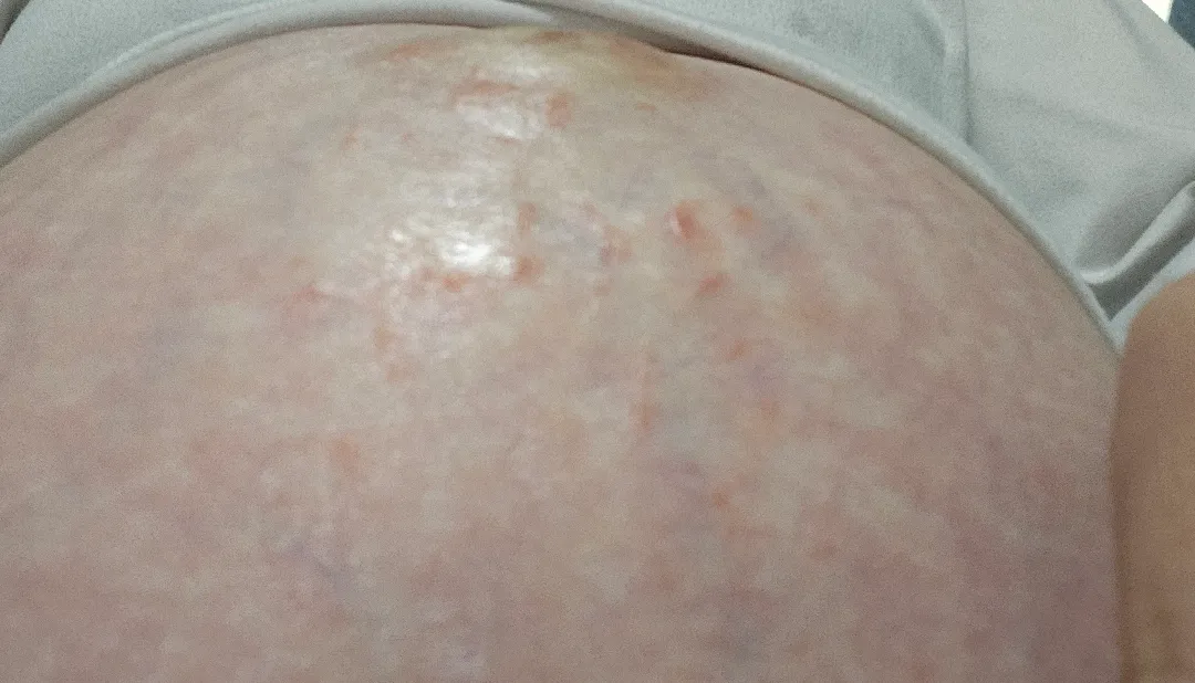 다들 33주  배 피부 상태어때요?