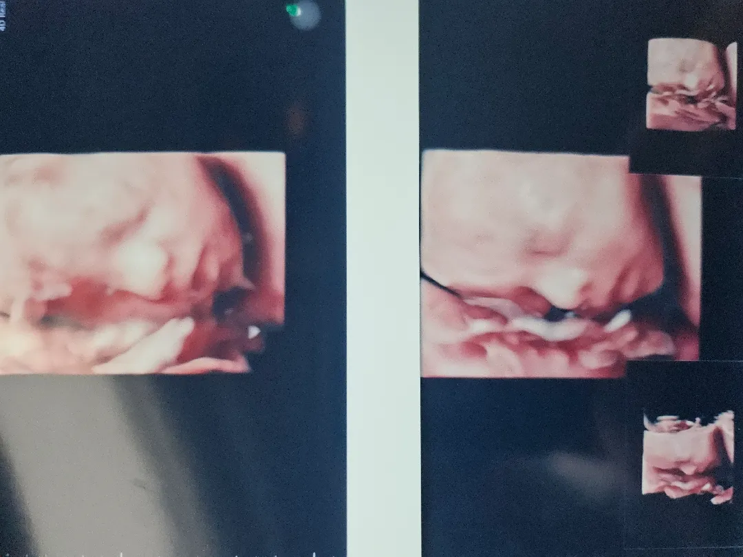 입체초음파