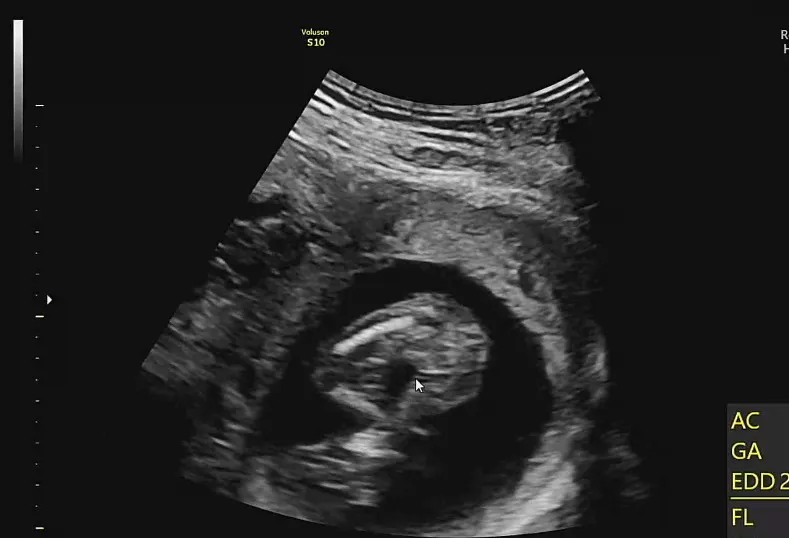 16주 2일 성별 확인