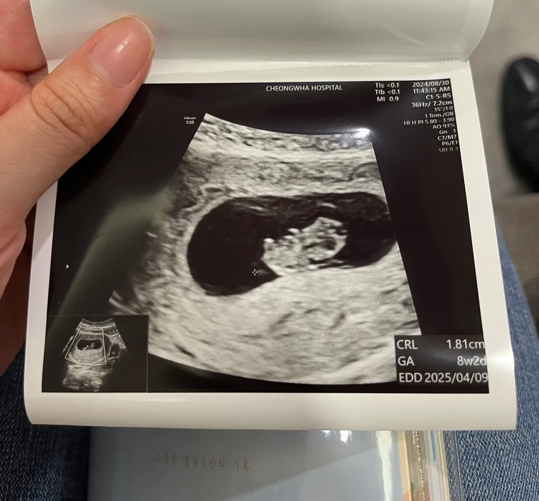 8주 2일 초음파 보고 왔어요