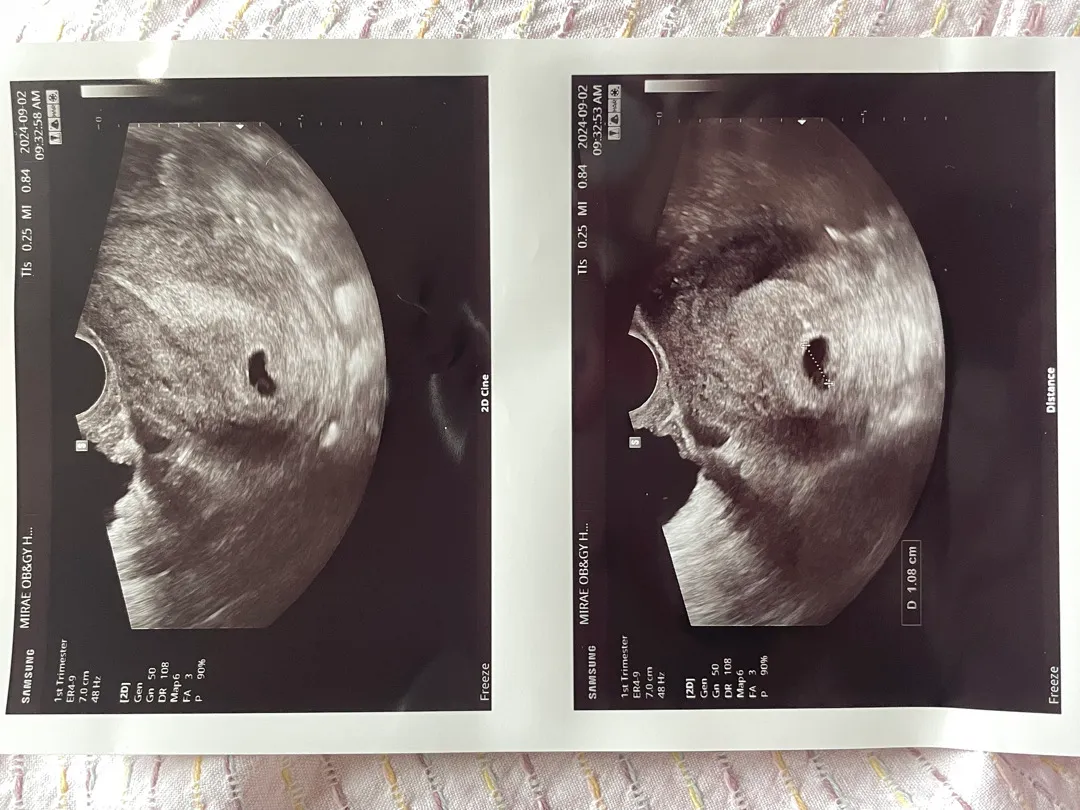 아기집 확인했어요👶🏻🩵