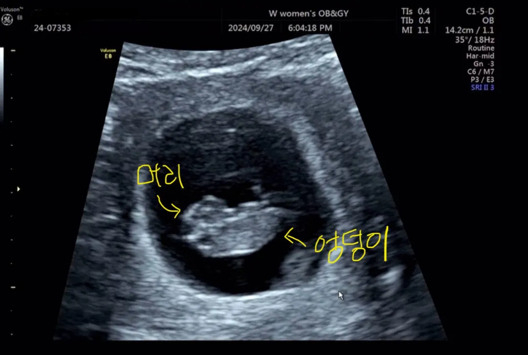 8주 6일차 ! 초음파 보고왔어요 ㅎㅎ