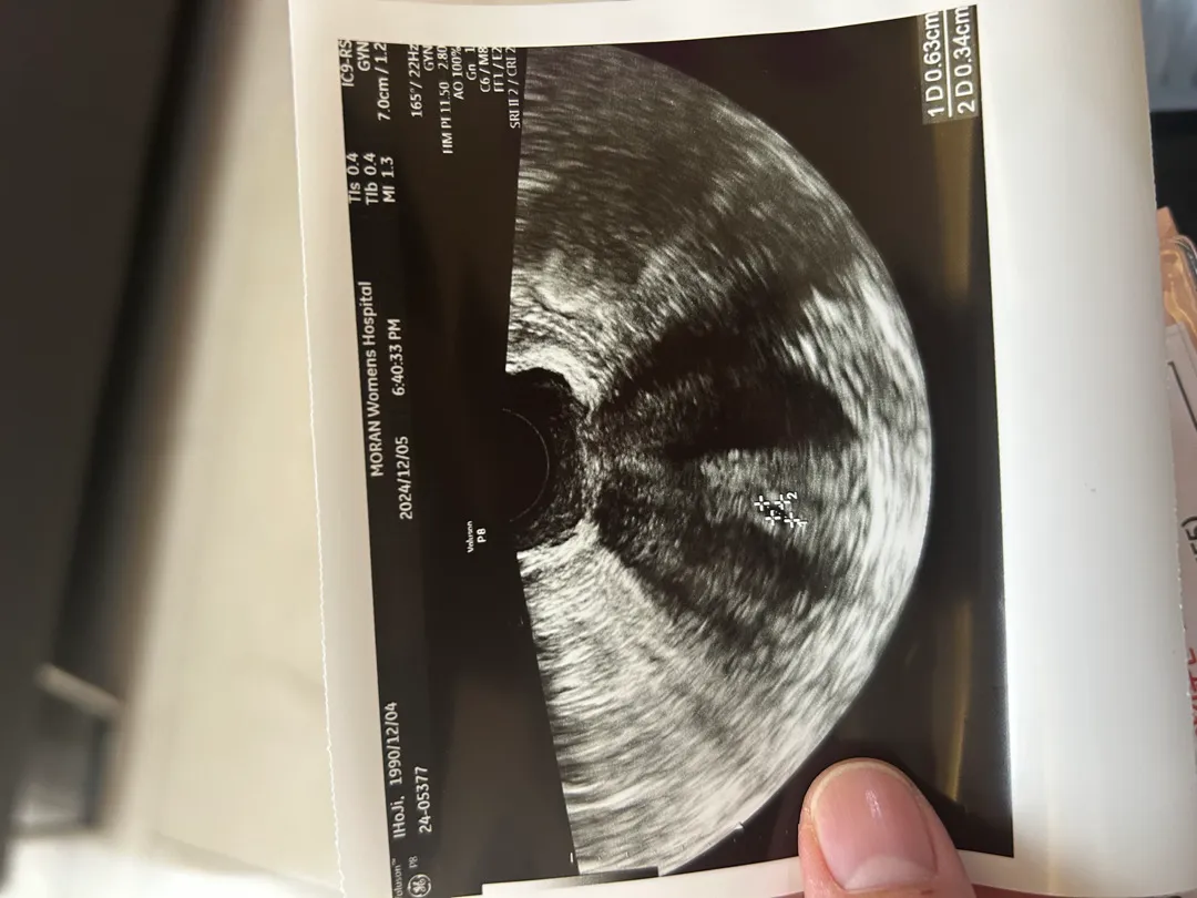 아기집 보고왔는데 입덧할때인가요?