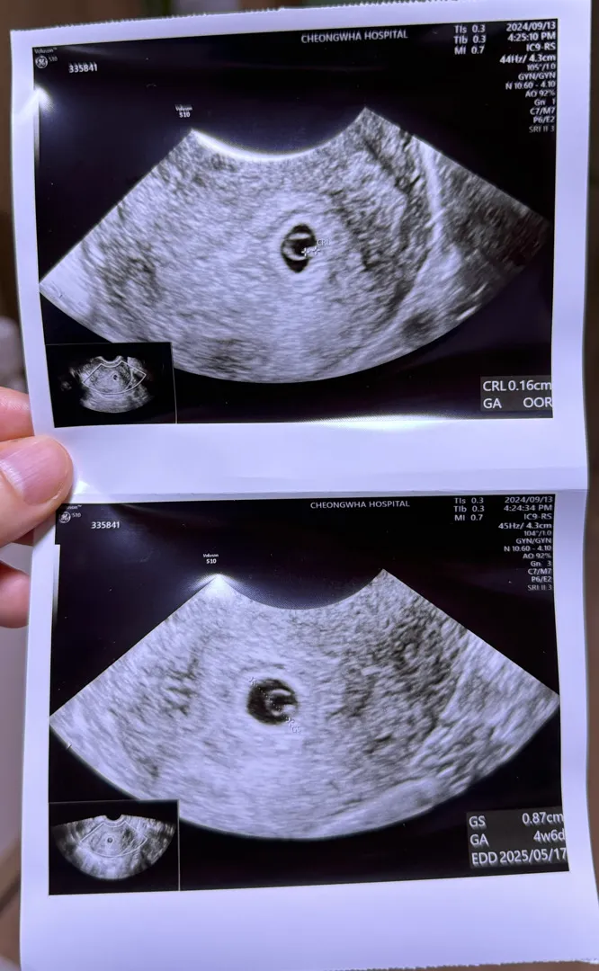 아기집크기가 작데요 ..