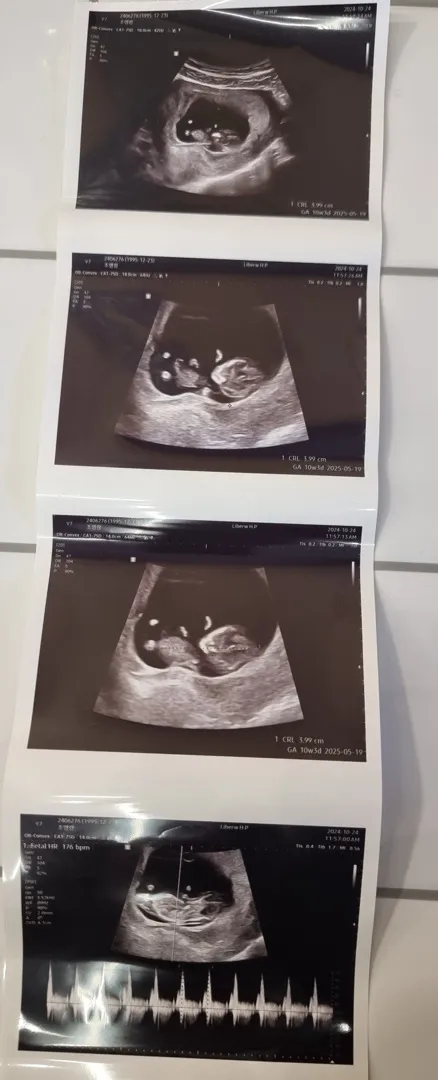 3주만에 다시 본 아기 초음파