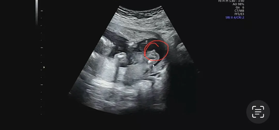 15주 딸인거 같다고 하셨는데 맞겠죠?