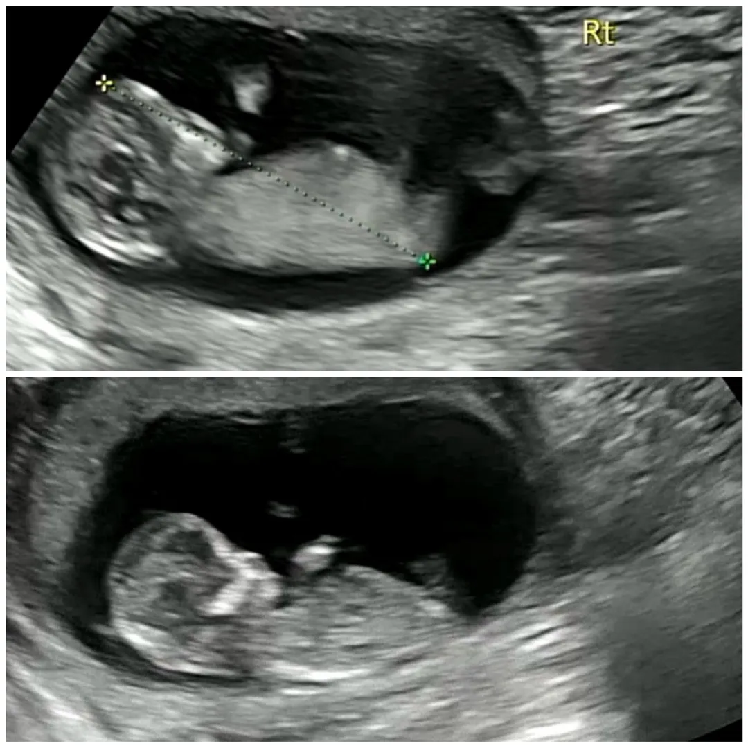 이란성쌍둥이 12주각도법 봐주실분