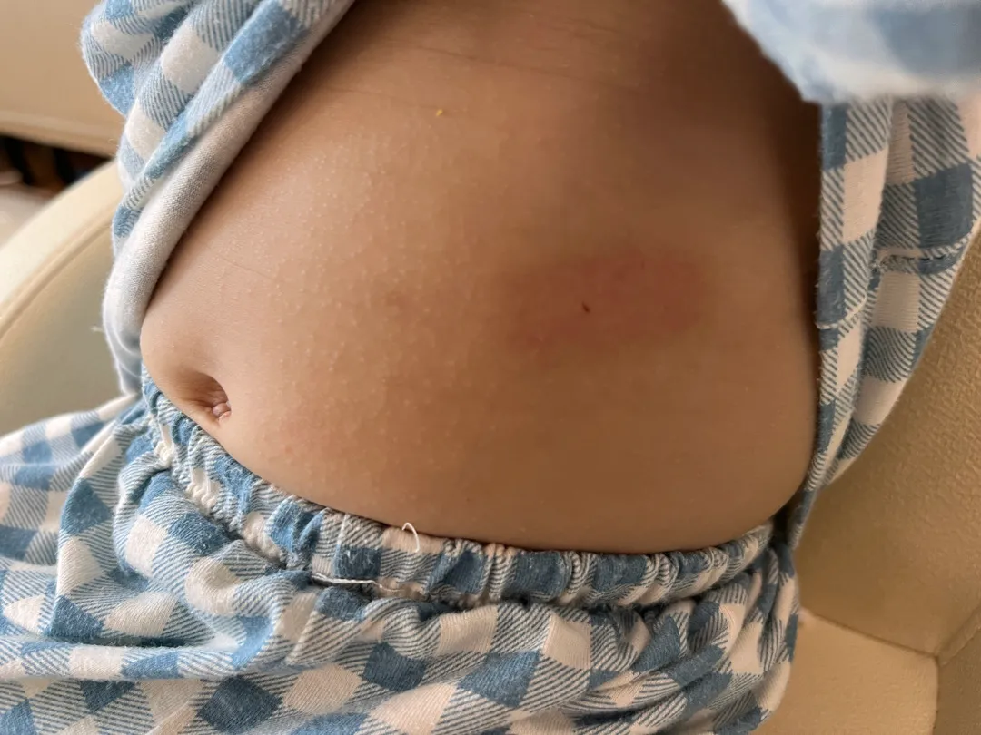 아토피 아기