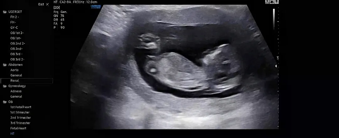 사랑둥이 맘님들..! 각도법 성별 대충이라도 알 수 있을까용🥹💙