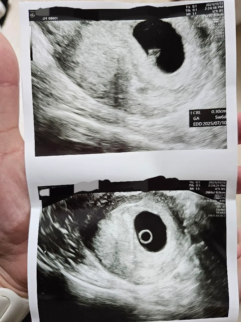 6주6일 계류유산 소견이후 임신유지 되신 분 있으신가요?
