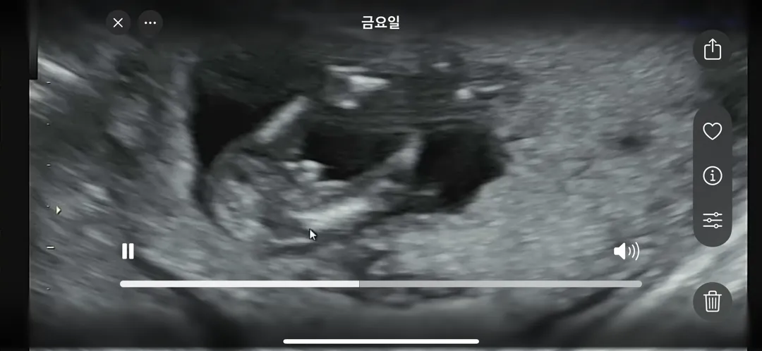 12주 초음파 다리사이