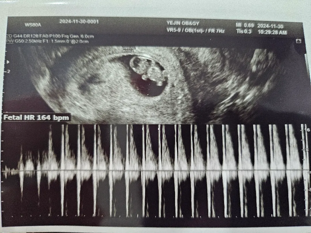 8주 3일 아기 팔다리 보고 왔어요!