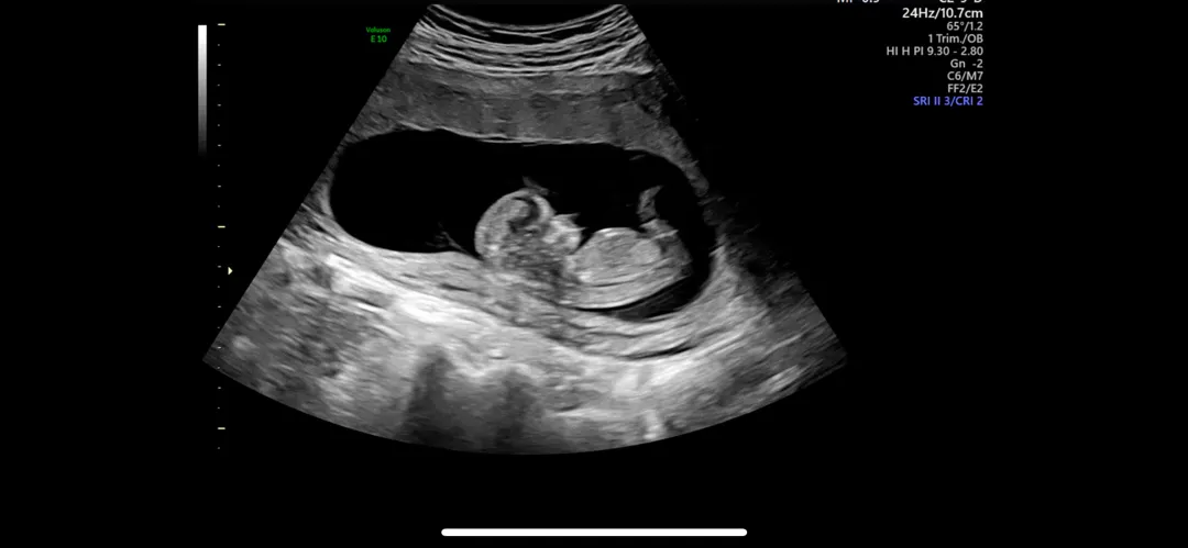 11주 6일 성별 추측
