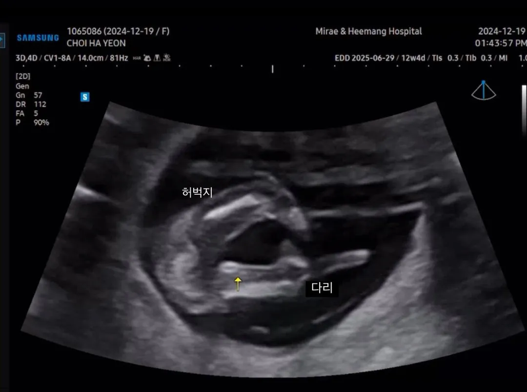 13주1일 초음파인데 다리사이에 아무것도 없어요!