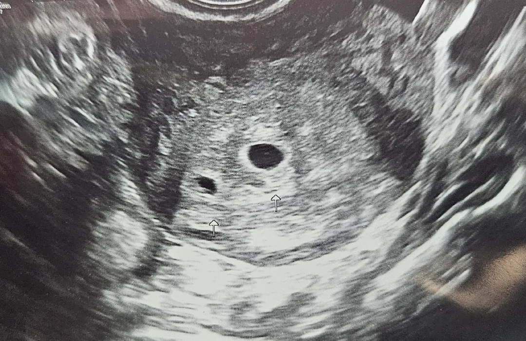 아기집2개?쌍둥이??