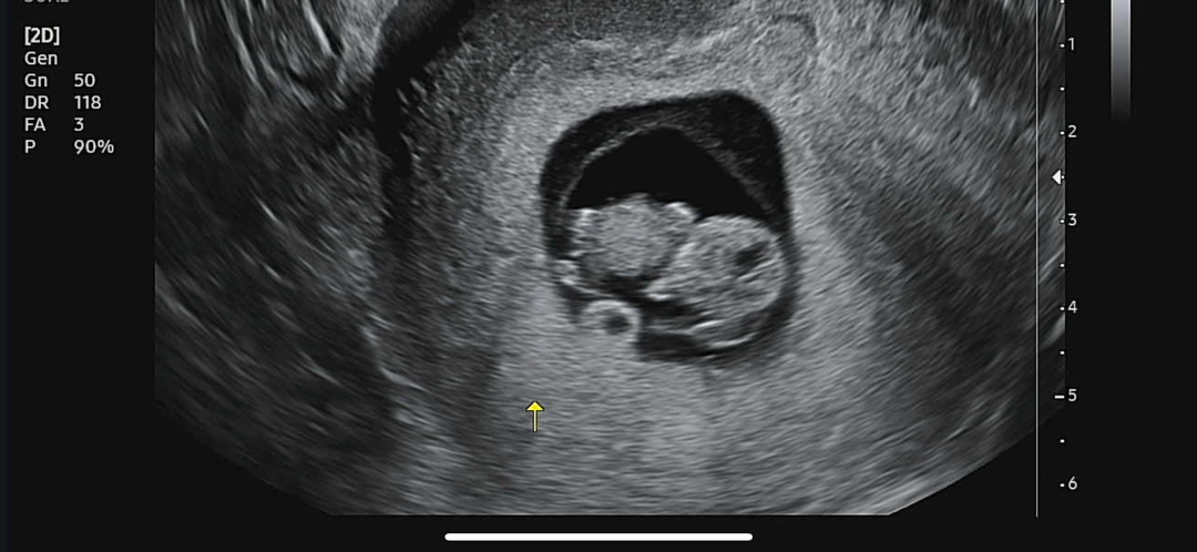 9주차 초음파(2.5cm젤리곰,196bpm)