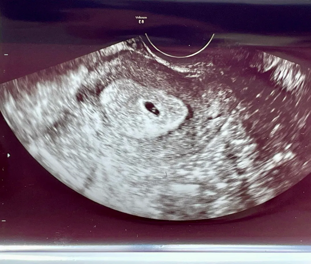 4주 6일 난황까지 보고왔어요