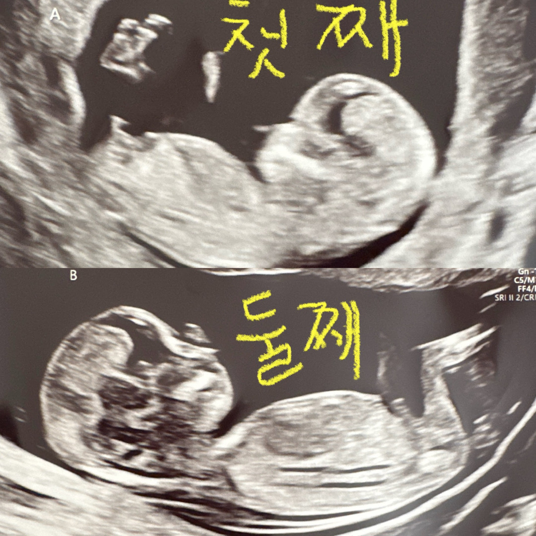 쌍둥이 12주 초음파 각도법 봐주세요
