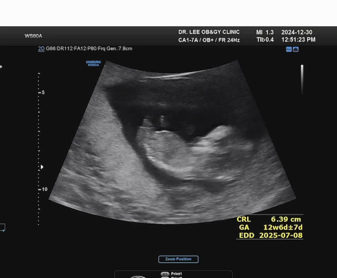 12주1일차 1차 기형아 검사하고왔어요!