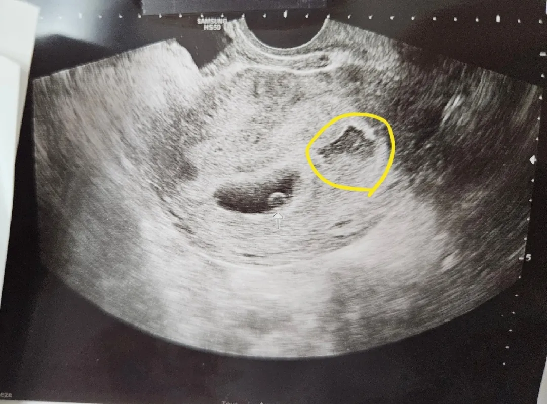 애기집 옆에피멍.. 유산기있다는데ㅠㅠ