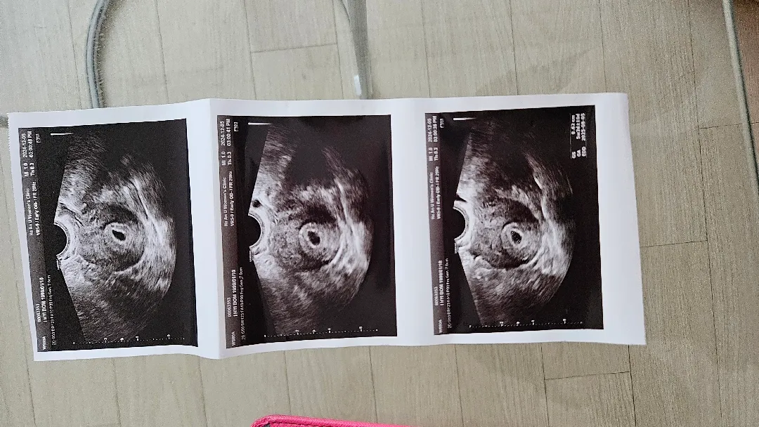 5주 2일차 아기집 보고왔습니다
