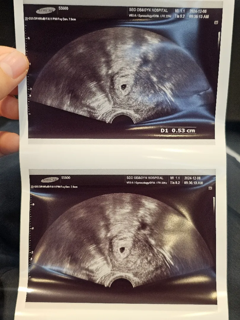 저도 아기집 자랑 ㅎㅎ 