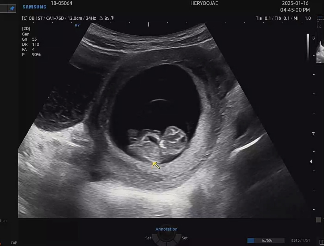 9주2일 초음파👶🏻젤리곰 건너뛰기...