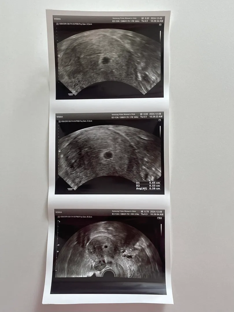5주차5일, 유산증상은 무엇이 있을까요 ?