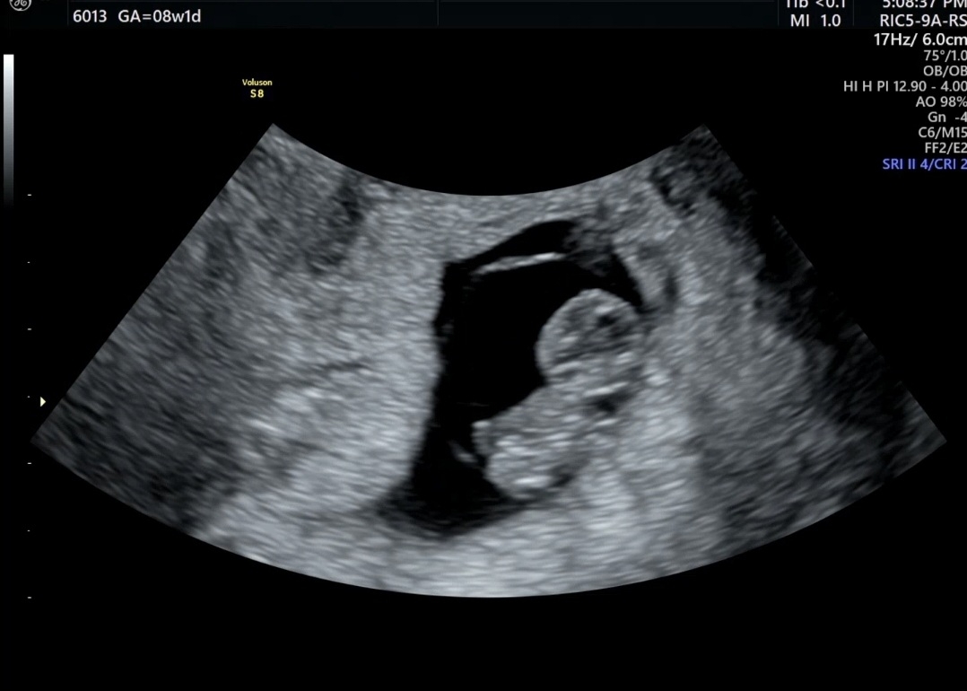 8주1일 동그란 머리 1.75cm ♡