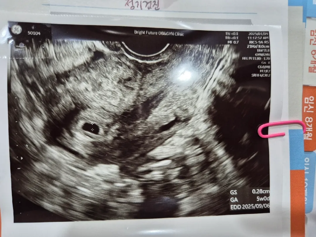 5주1일차 아기집 확인했어요~❣️