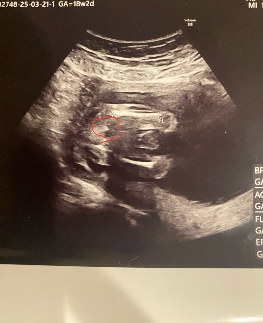 18주 이거🌶️인가요??