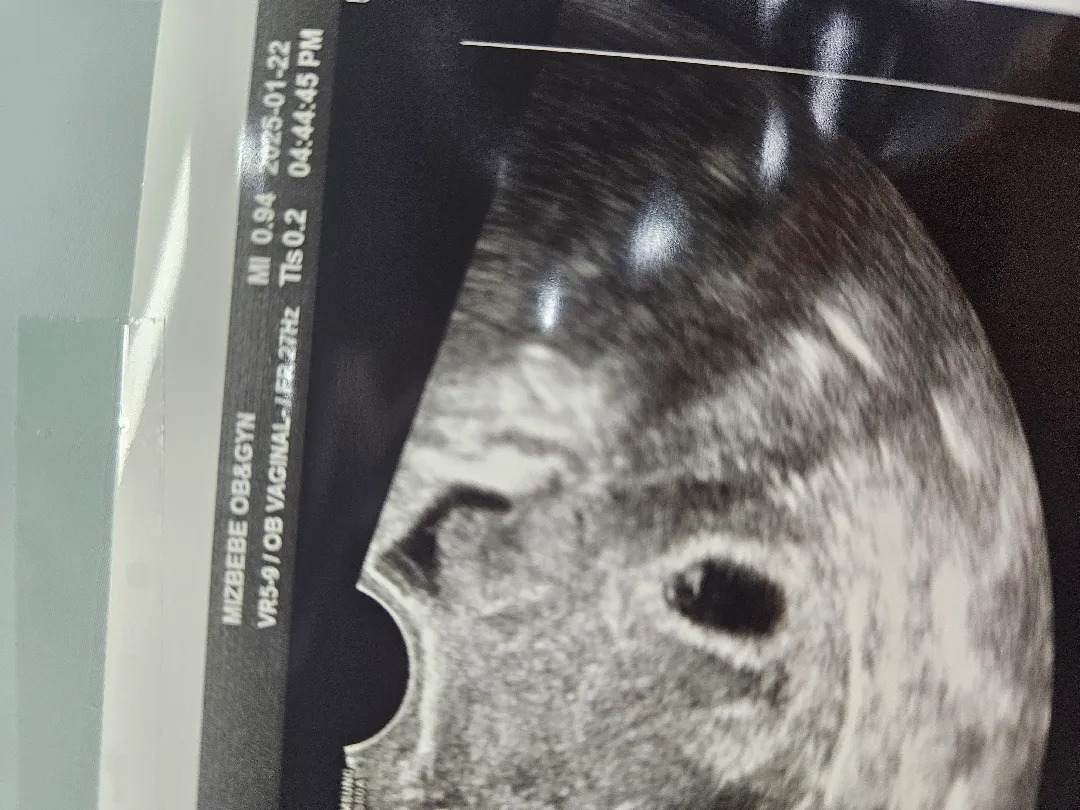6주5일 초음파및 잔기침문제