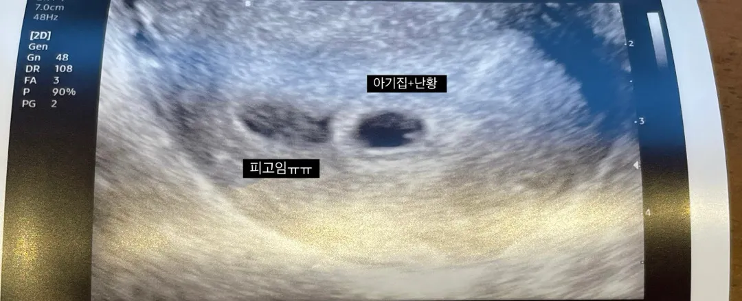 5주차 아기집 옆 피고임 ㅠㅠ