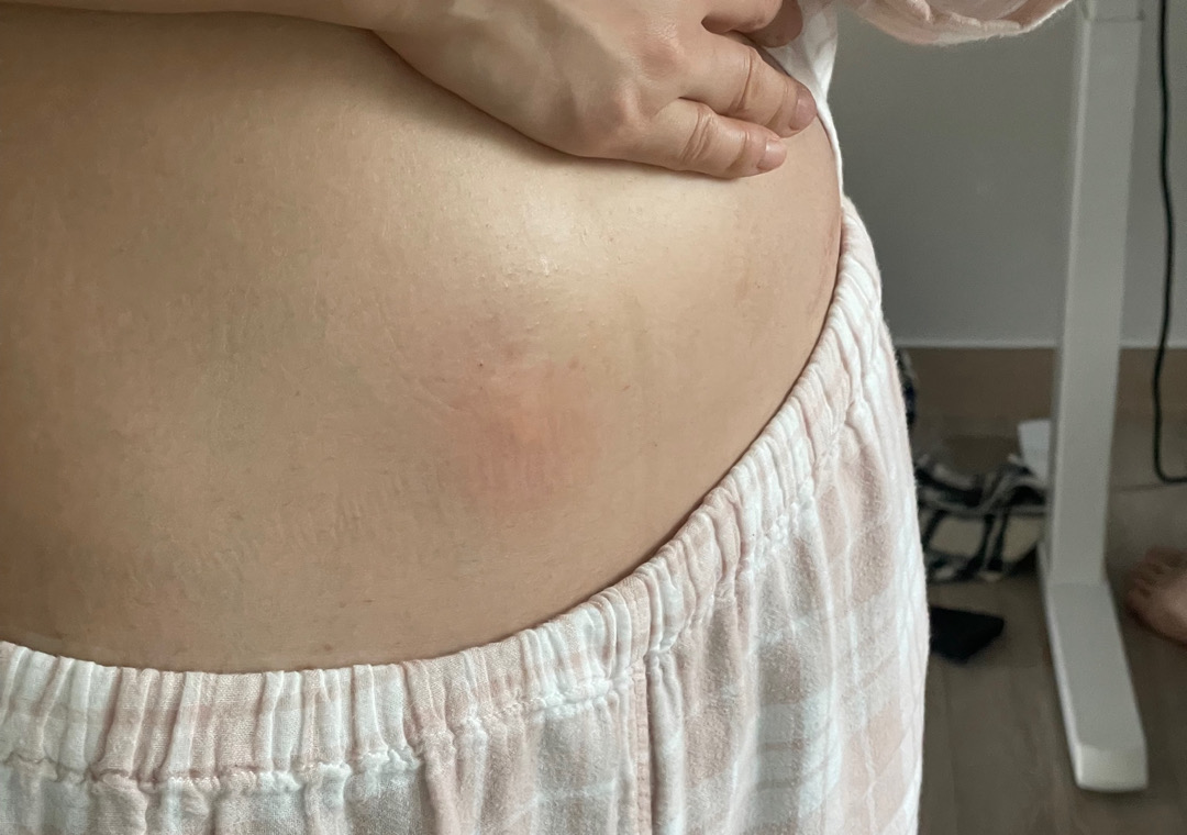 프롤루텍스 부작용 ..? 한번도 이런적 없어요! 