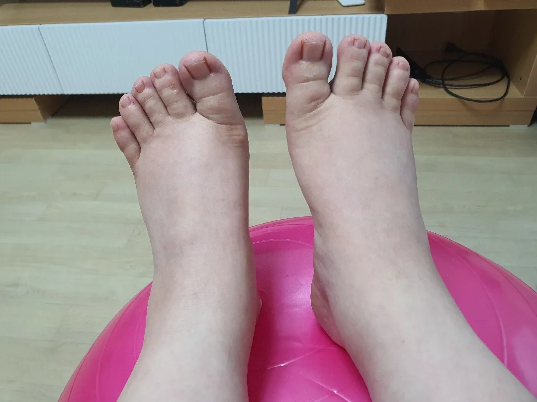 이 정도 붓는게 맞나요..?ㅠㅠ..