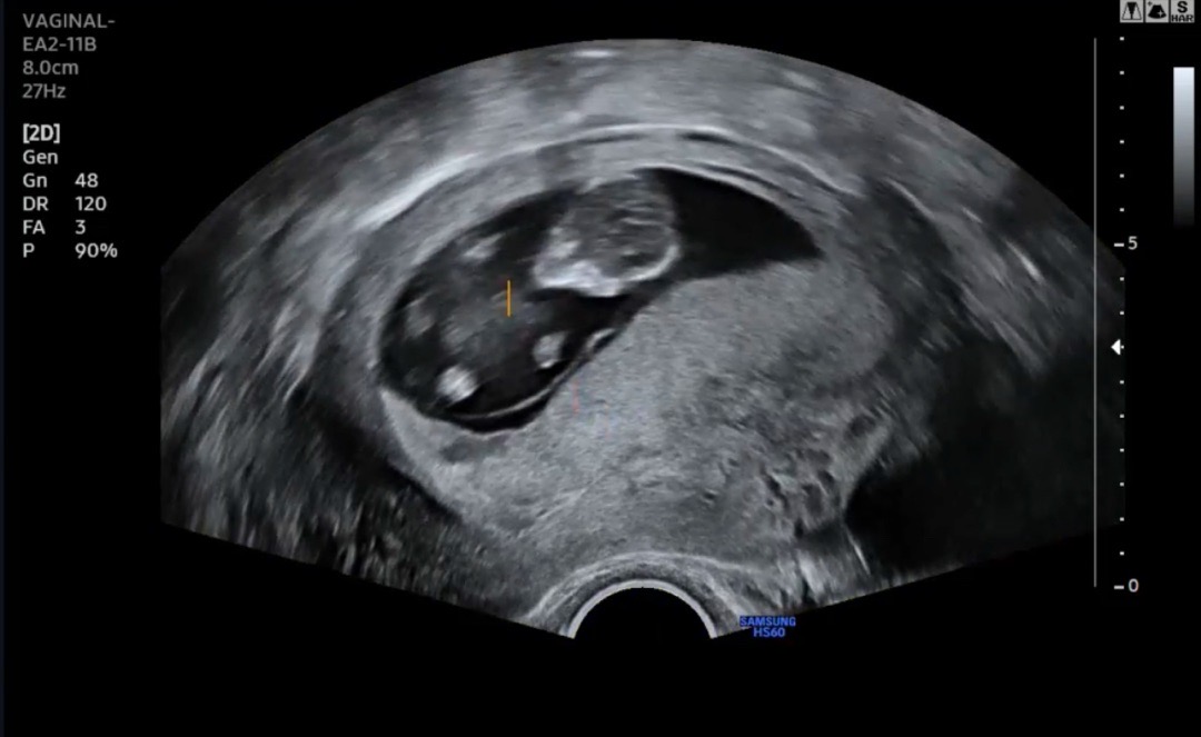 11주차 정밀검진