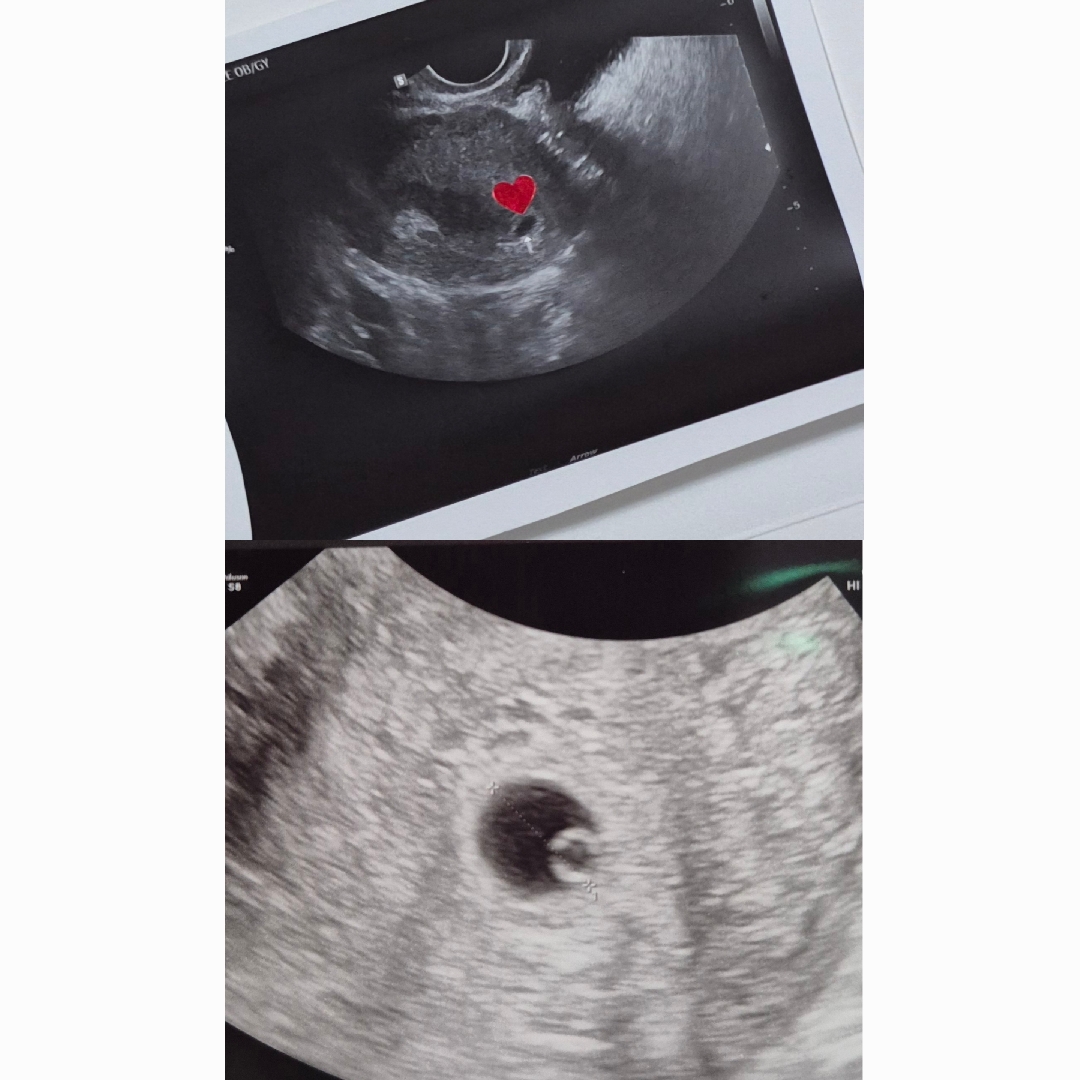 아기집🐟->난황💍->심장소리❤️