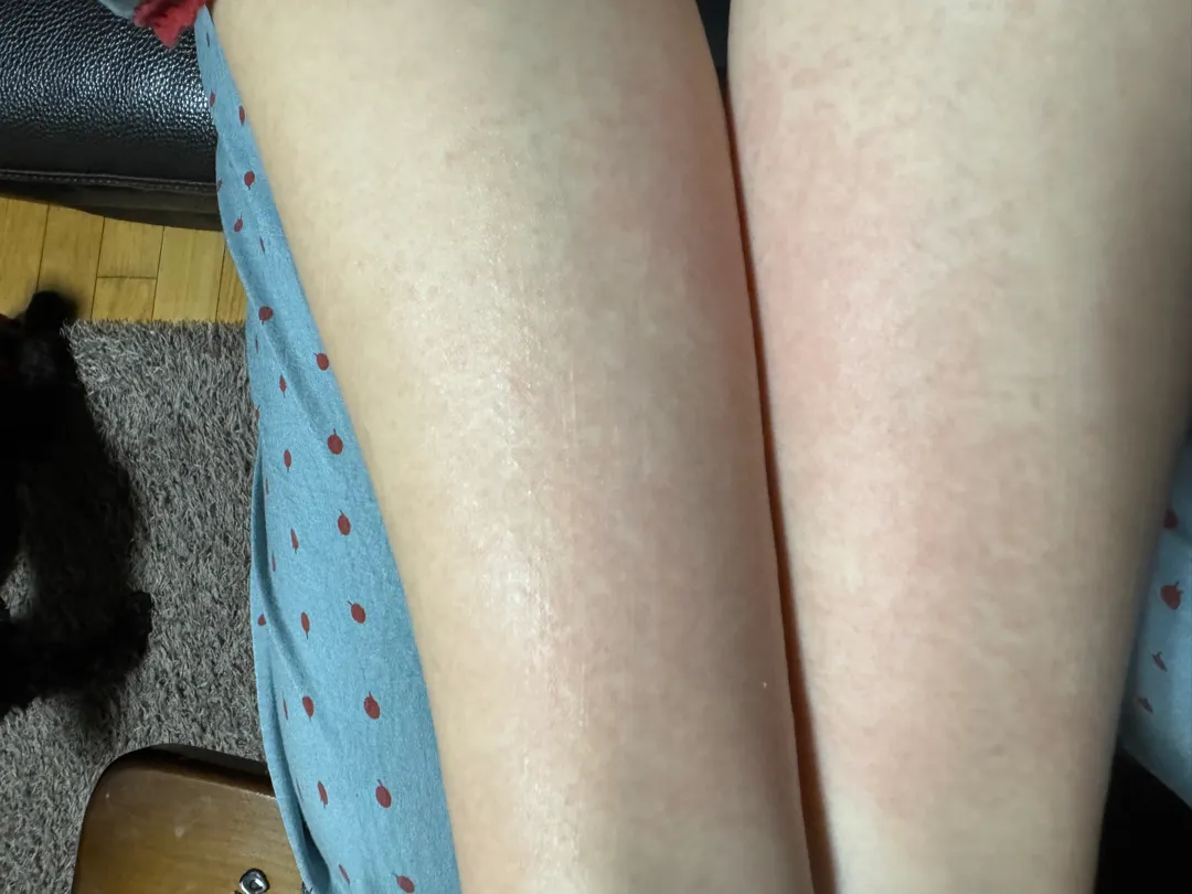 임산부 피부병 왜 생겼을까요?? 약은 발라도 될까요??