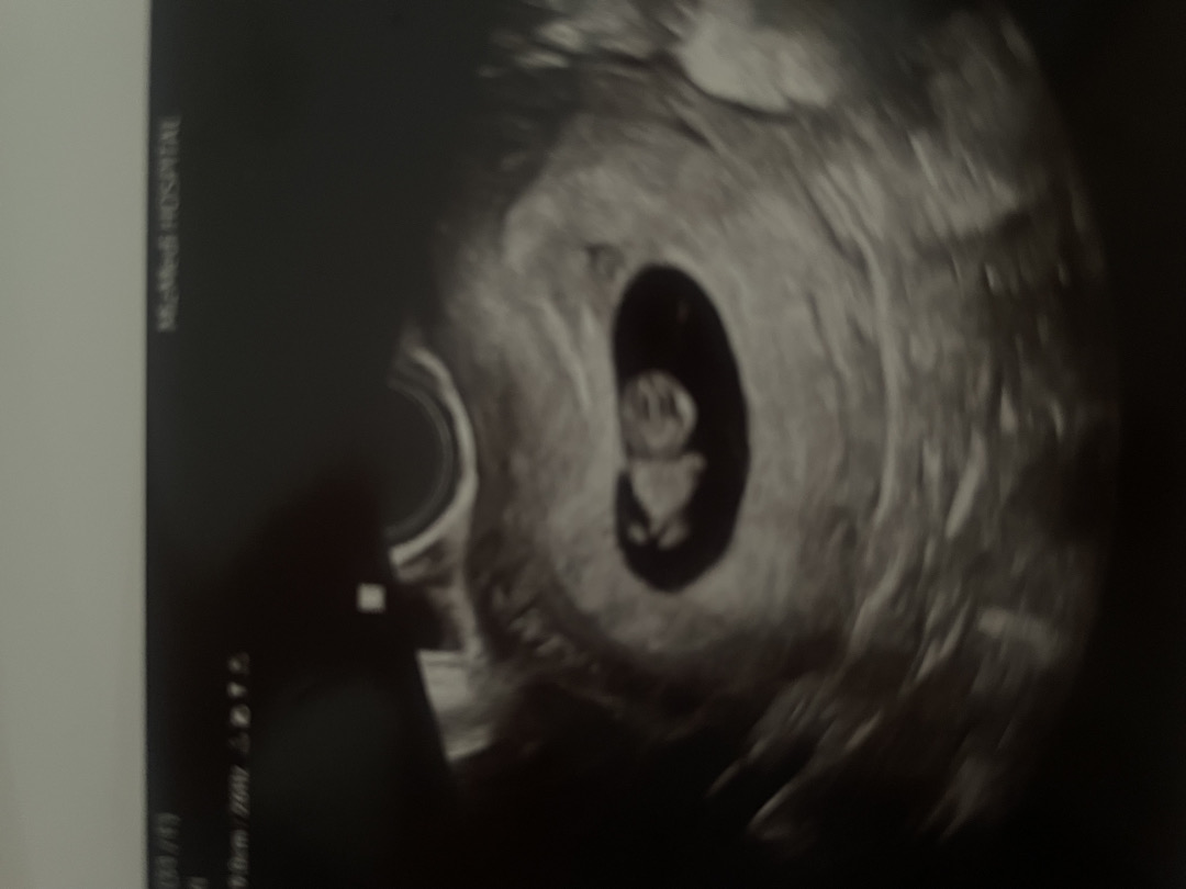 8주6일 초음파 머리