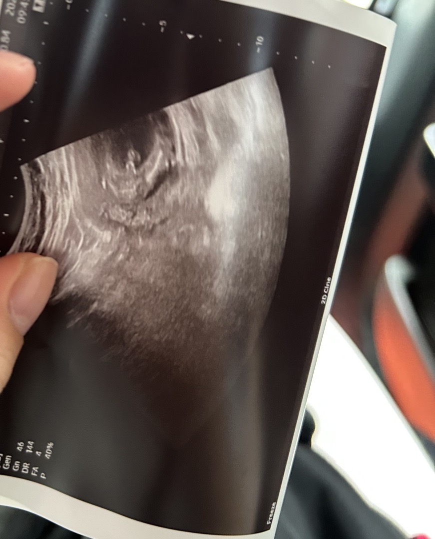 15주4일차 초음파 한번만 봐주세요