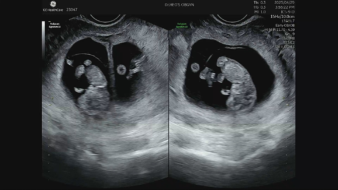 10주 1일차 둥이 촘파