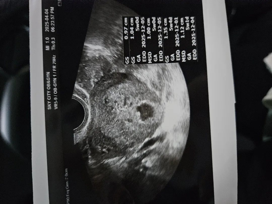 옅은 선홍빛 피비침보고 초음파 보고오기